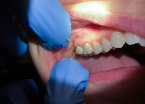 Best Lost Filling or Crown Replacement in Ravenna, MI