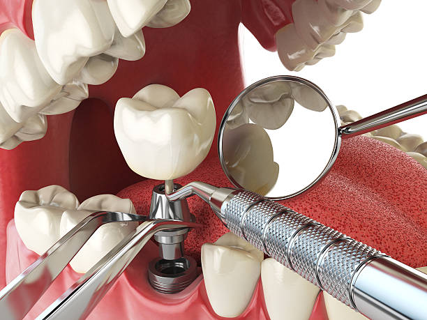 Best Emergency Wisdom Tooth Extraction in Ravenna, MI